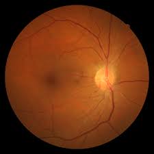 Retinopati-Hipertensi