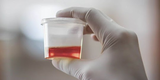 urine-darah